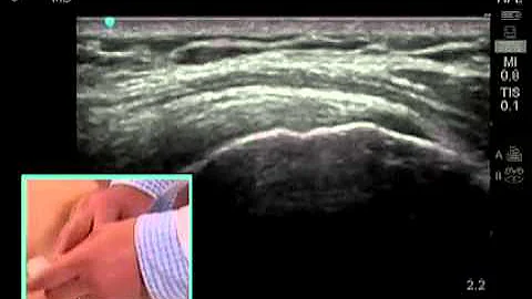 How To: Ultrasound Guided Shoulder Injection Scanning Technique Video