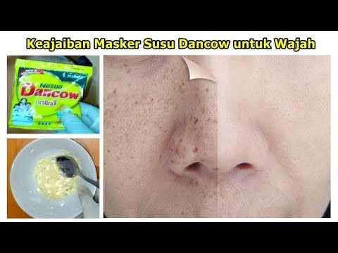 menghilangkan-jerawat-dan-bekas-jerawat-dengan-susu-dancow
