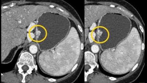 MDCT Evaluation of Gastric Malignancies: Adenocarcinoma, GIST & Beyond Part 1