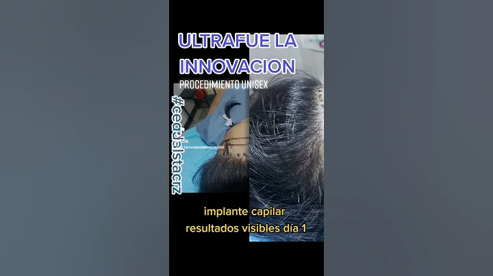 Implante Capilar ULTRAFUE Bolivia dr. Alvaro Larrosa