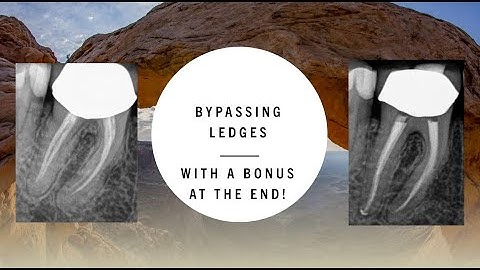 Lower molar retreatment bypassing ledges AND the squirt technique explained