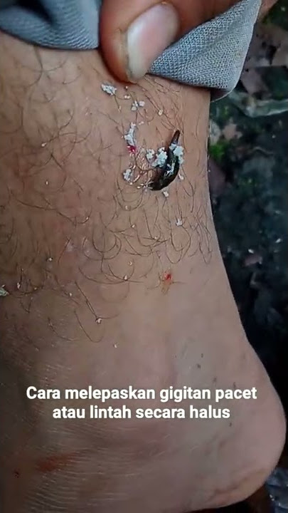 JANGAN PANIK! | LAKUKAN CARA INI JIKA KAMU DIGIGIT PACET ATAU LINTAH
