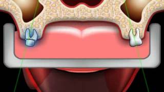 Problems with Dental Impressions
