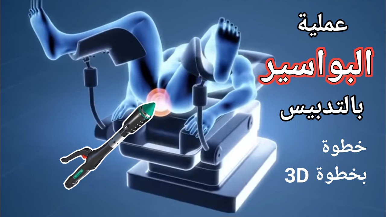 شرح عملية البواسير بالتدبيس خطوة بخطوة 3D | رحلة علاج البواسير نهائيا  | دروس طبية