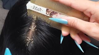 The Ultimate Scalp Scratch Experience 🌿  ASMR Tingles for Deep Sleep VF00376 screenshot 4