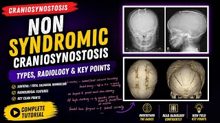 Non Syndromic Craniosynostosis Explained !