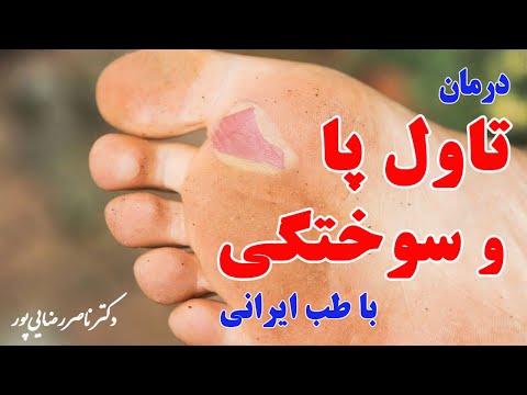 تصویری: چگونه می توان از برآمدگی خلاص شد: چه داروهای طبیعی می تواند کمک کند؟