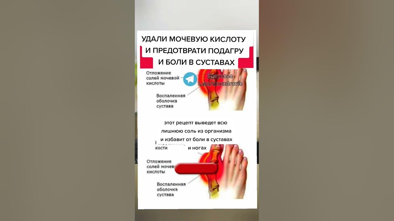 Травы выводящие мочевую кислоту из организма