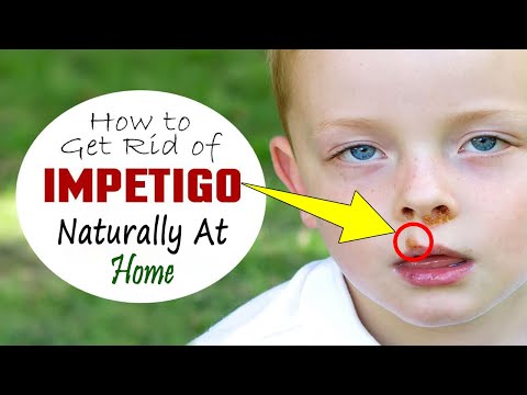 How to Get Rid of Impetigo || Home Remedies for Impetigo Treatment