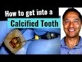 Calcified Tooth (How to Root Canal -Critical Tips!)