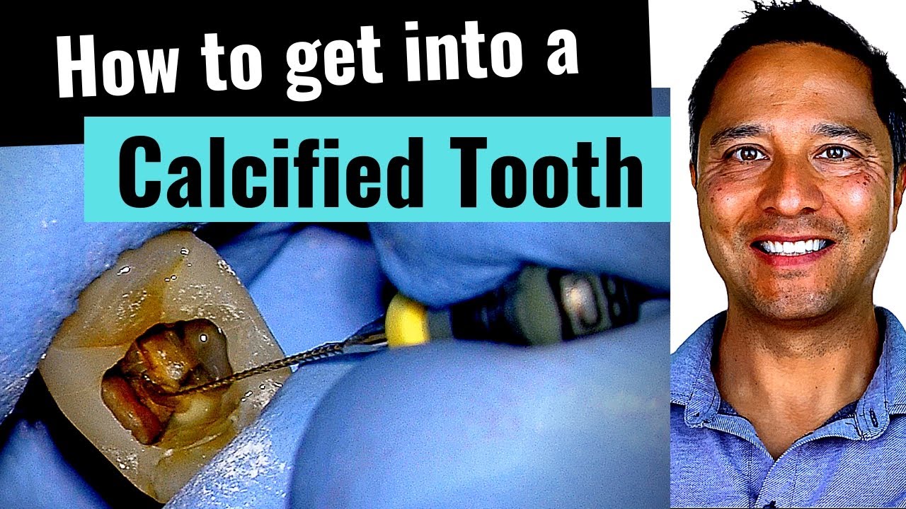 Calcified Tooth How To Root Canal Critical Tips Youtube