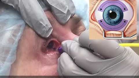 Micropulse trans-scleral cyclophotocoagulation (MpCPC) - Cyclo G6 Glaucoma Laser System