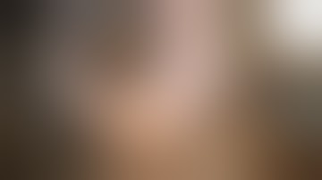 Using Iris Hooks for Phacoemulsification in a Cataract with Small Pupil