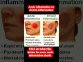 acute inflammation vs chronic inflammation sjpharma pwpharma pwmededLS preplad csir life sciencejam