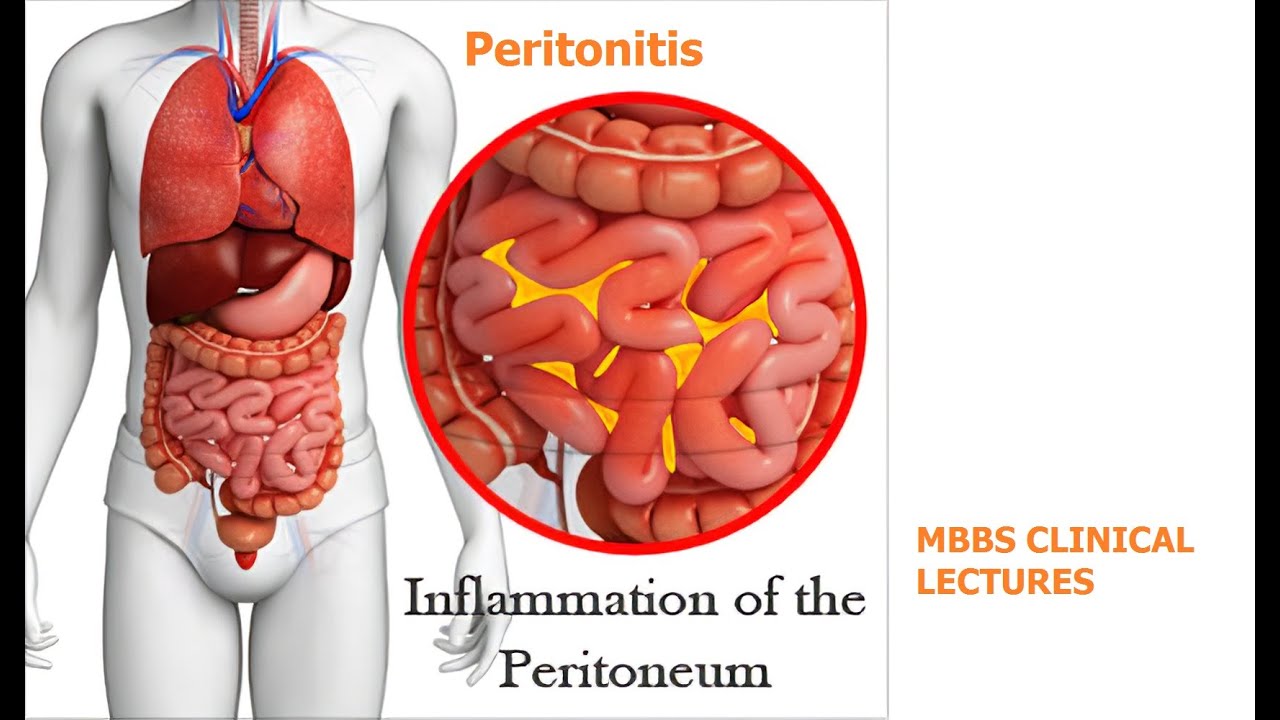 peritonitis-youtube