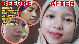 5 SKINCARE AMPUH UNTUK KULIT KUSAM,BERMINYAK & BERJERAWAT