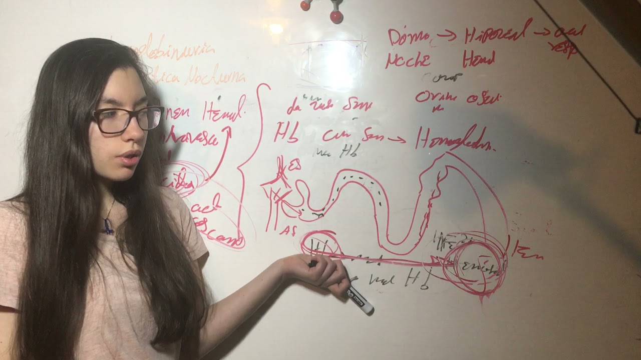 Hemoglobinuria Paroxistica Nocturna: Patofisilogia/Cuadro Clinico/Complicaciones, Dx, Tx