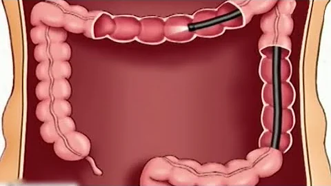 ¿Se puede poner desodorante antes de una colonoscopia?