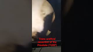 Trans Urethral Resection of Prostate (TURP)