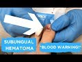 BLOOD TRAPPED UNDER NAIL! (SUBUNGUAL HEMATOMA) **BLOOD WARNING**