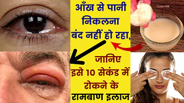 आँख से पानी निकलना बंद नहीं हो रहा, जानिए कारण और इलाज| Home remedy for watery eyes