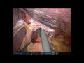 Gastric sleeve revision  hiatal hernia repair ahad khan md