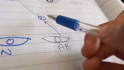 Primary and Secondary Deviations of Eye | Squint