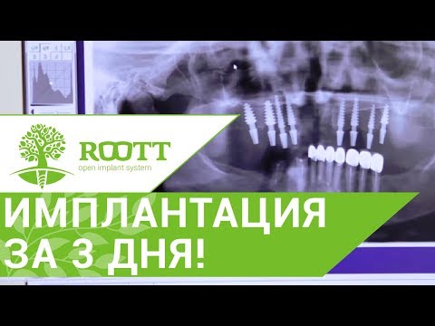 Имплантация с немедленной нагрузкой за 3 дня, 84 года. Клиника ROOTT