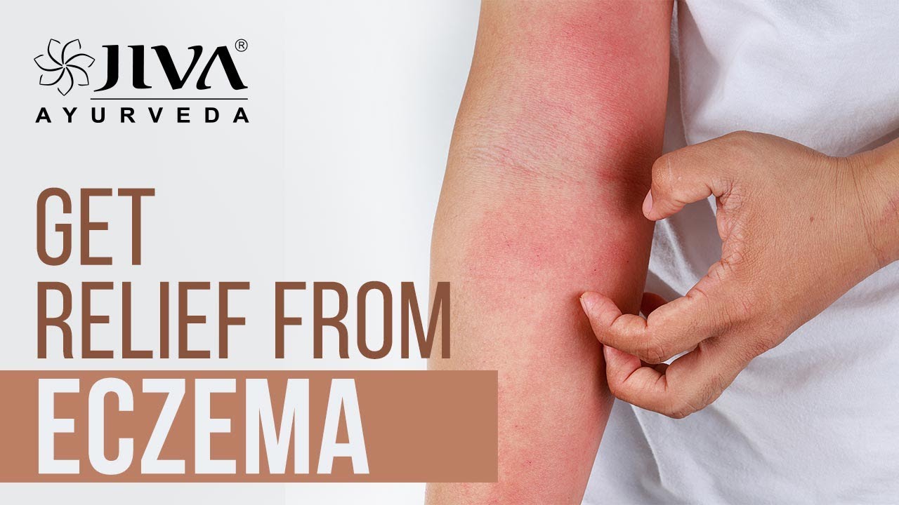 Get Relief from Eczema एक्जिमा से राहत Jiva Health Show YouTube