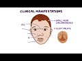 PGAP3-congenital disorder of glycosylation (Year of the Zebra)