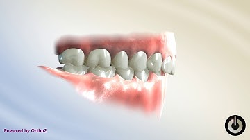 Curve of Spee Correction   Step Archwire, Lower