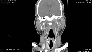CASE 1015 CT VOCAL CORD PARALYSIS DISH