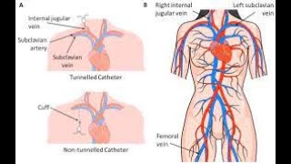 Tunneled intraperitoneal catheter CPT code - simplify medical coding