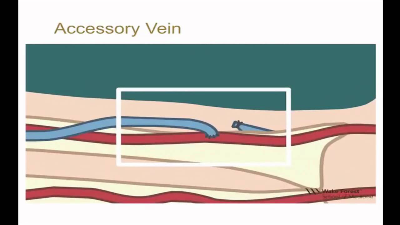10minute Rounds Accessory Vein and the Arteriovenous Fistula YouTube