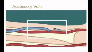 10-minute Rounds:  Accessory Vein and the Arteriovenous Fistula