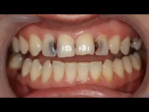 Видео: ★★ Как вылечить кариес в домашних условиях. Домашняя стоматология при кариесе зубов.