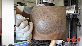 Getting Real Series - Going Bald and Scalp Micropigmentation