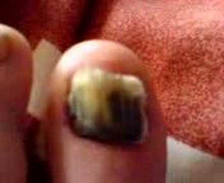 my big toe got smashed up ridin my motocross bike and my nail fell off!!! lovely.