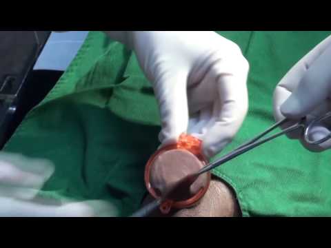 ShangRing - Non-Flip Circumcision Surgery With Topical Anesthesia (Video 2)