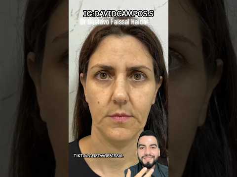 LA ARMONIZACIÓN FACIAL