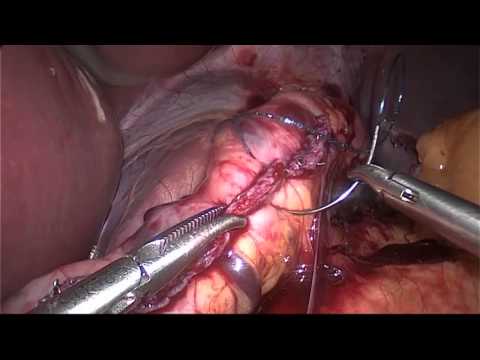 Sleeve Gastrectomy