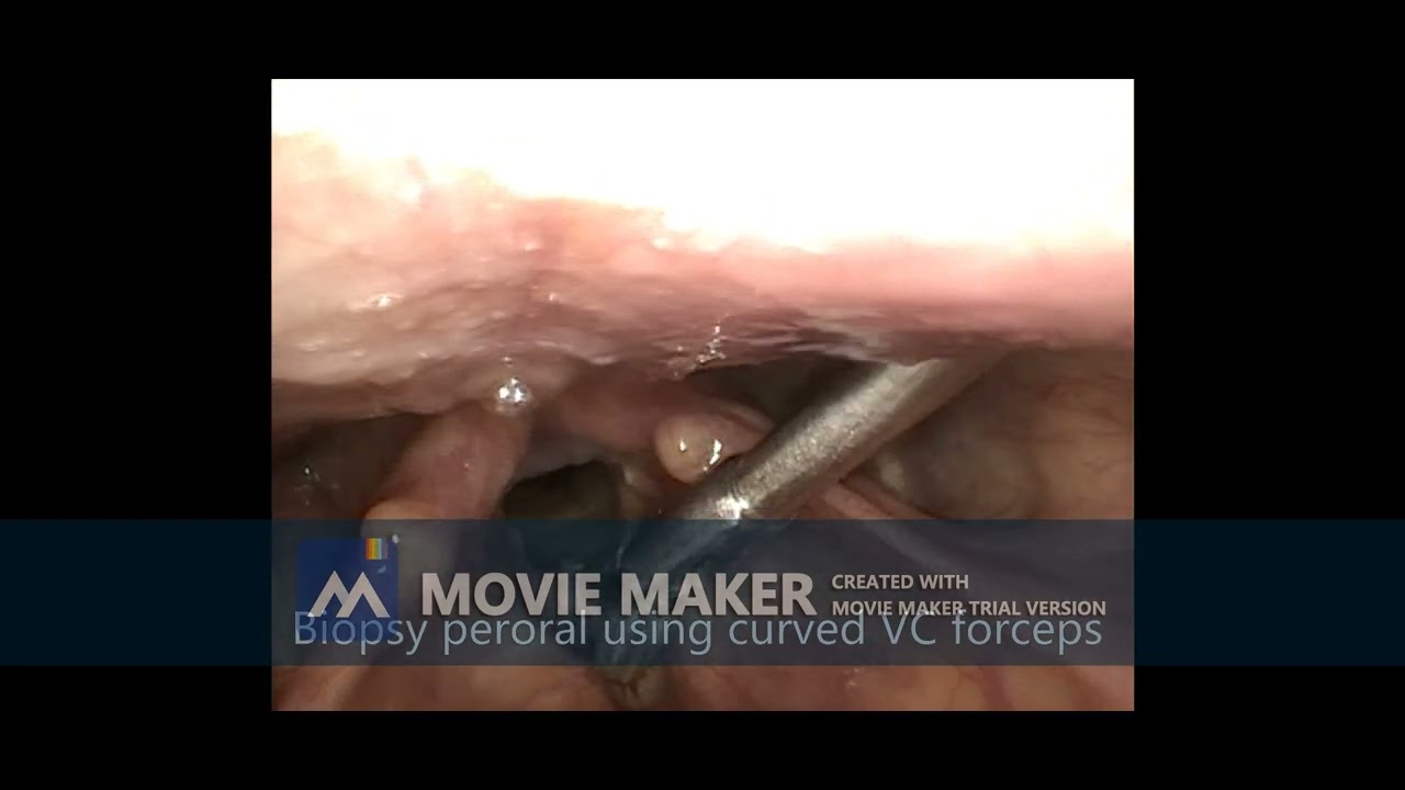 Excisional biopsy of right VC mass under LA