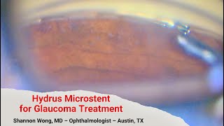 Hydrus stent for Glaucoma treatment. Shannon Wong, MD
