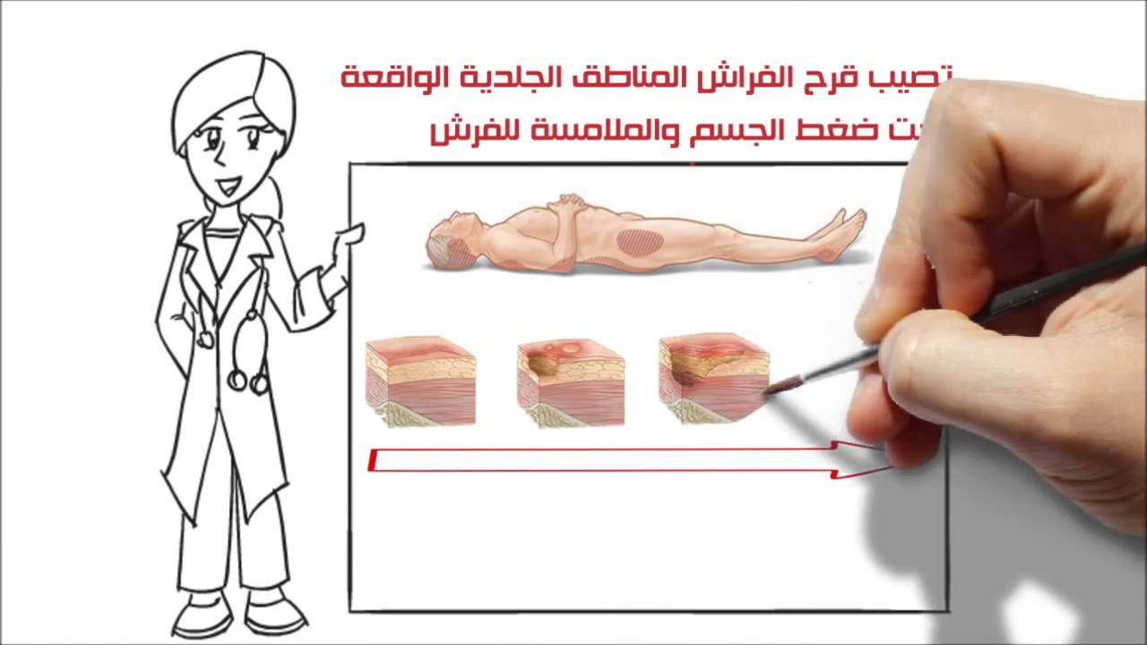 العلاج الأمثل لمشكلة قرح الفراش Youtube