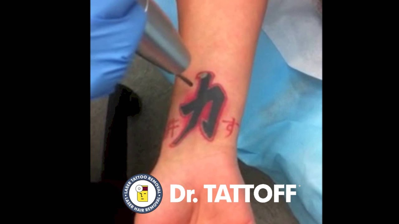 Tattoo Removal - Phoenix Arizona - Wrist Tattoo Removed During Tattoo ...