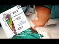 Bilateral adductor tenotomy  cerebral palsy with multiple contractures lowr limbs release  adamya