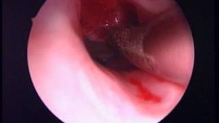 Microdebrider Removal Of Laryngeal Papillomas - ENT Consultant London - ENT Surgery London
