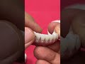 Lower World class full mouth implant zirconia case!