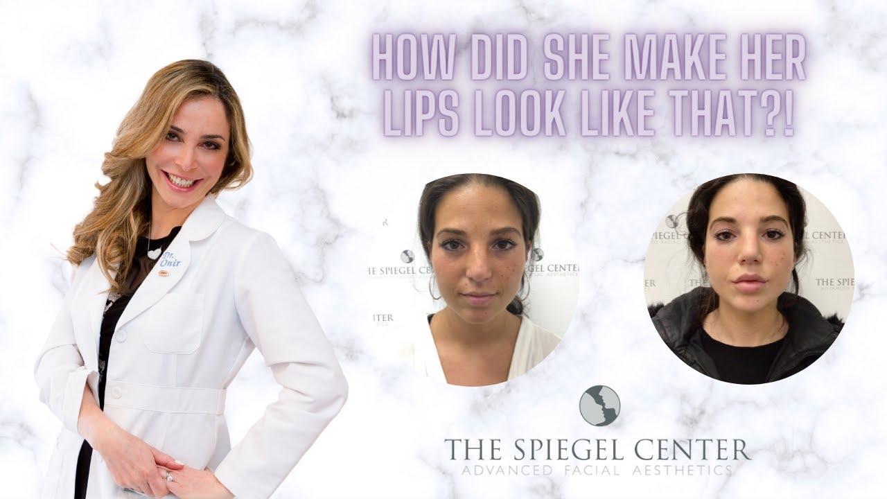 Lip Fillers  The Spiegel Center