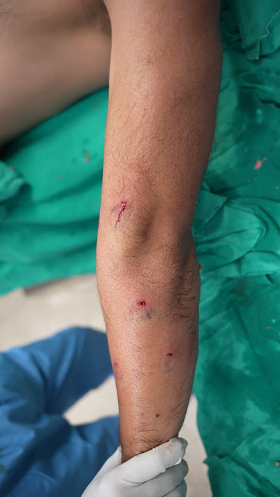 Lipoma Removal #shortvideo #shorts #dezireclinicindia